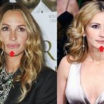 Julia Roberts lip plastic surgery (18)