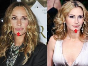 Julia Roberts lip plastic surgery (18)