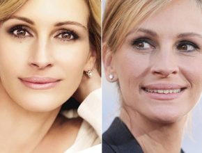 Julia Roberts before and after plastic surgery (16)