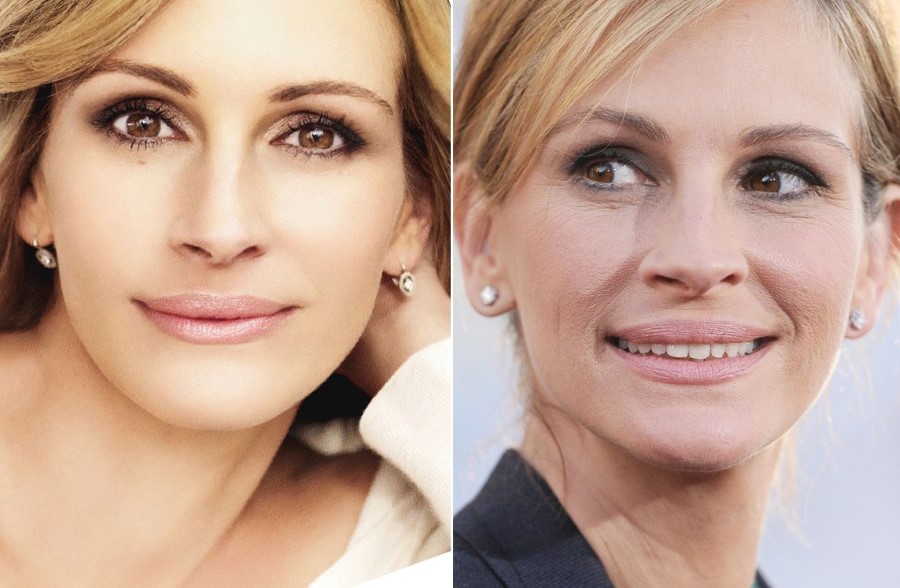 Julia Roberts before and after plastic surgery (16)