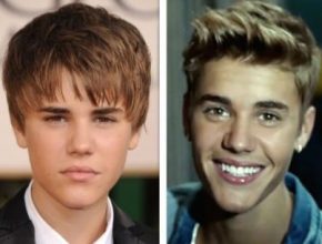 Justin Bieber before and after plastic surgery