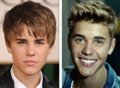 Justin Bieber before and after plastic surgery