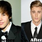 Justin Bieber before and after plastic surgery (18)