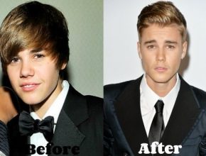 Justin Bieber before and after plastic surgery (18)