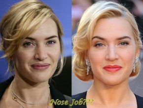 Kate Winslet before and after nose job (26)