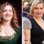 Kate Winslet before and after plastic surgery (13)