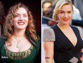 Kate Winslet before and after plastic surgery (13)