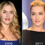 Kate Winslet before and after plastic surgery (17)