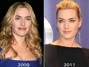 Kate Winslet before and after plastic surgery (17)