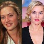 Kate Winslet before and after plastic surgery