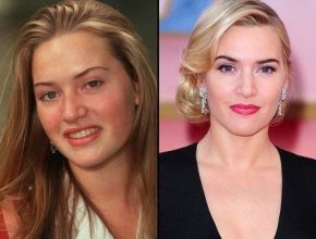 Kate Winslet before and after plastic surgery