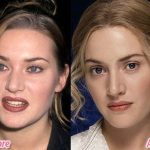 Kate Winslet before and after plastic surgery (22)