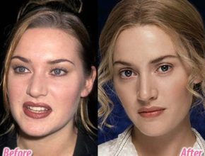 Kate Winslet before and after plastic surgery (22)