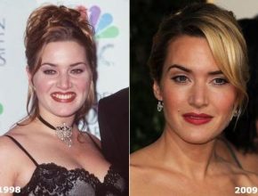 Kate Winslet before and after plastic surgery (24)