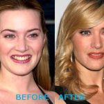 Kate Winslet before and after plastic surgery (27)