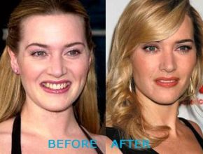 Kate Winslet before and after plastic surgery (27)