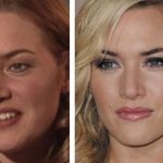 Kate Winslet plastic surgery (6)