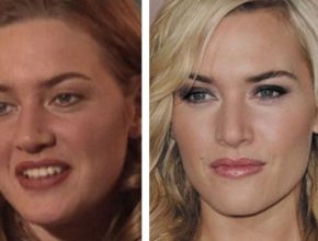 Kate Winslet plastic surgery (6)