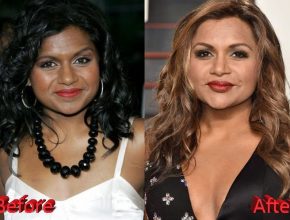 Mindy Kaling before and after plastic surgery