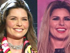 Shania Twain before and after plastic surgery (1)
