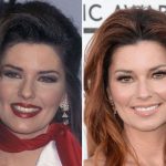 Shania Twain before and after plastic surgery (22)