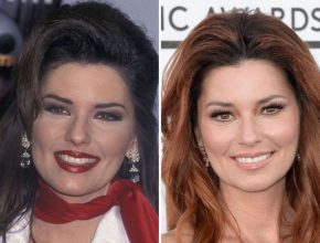 Shania Twain before and after plastic surgery (22)