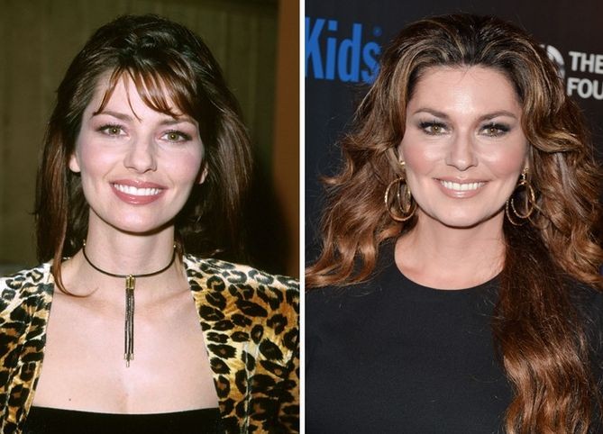 Shania Twain before and after plastic surgery