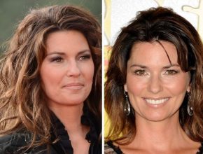Shania Twain before and after plastic surgery (27)