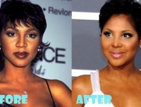 Toni Braxton before and after plastic surgery (30)