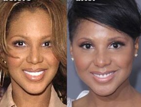 Toni Braxton before and after plastic surgery (33)