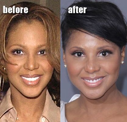 Toni Braxton before and after plastic surgery (33) .
