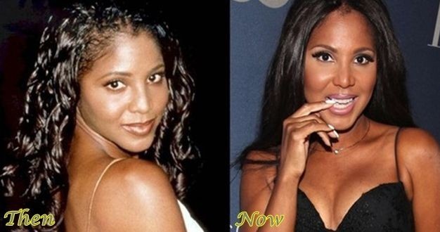 Toni Braxton before and after plastic surgery