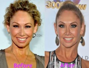 Kym Johnson before and after plastic surgery (18)