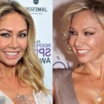 Kym Johnson before and after plastic surgery