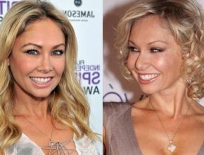 Kym Johnson before and after plastic surgery