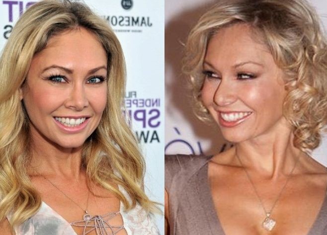Kym Johnson before and after plastic surgery