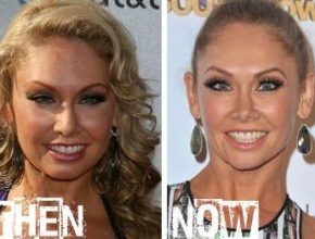 Kym Johnson before and after plastic surgery