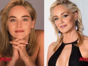 Sharon Stone before and after plastic surgery