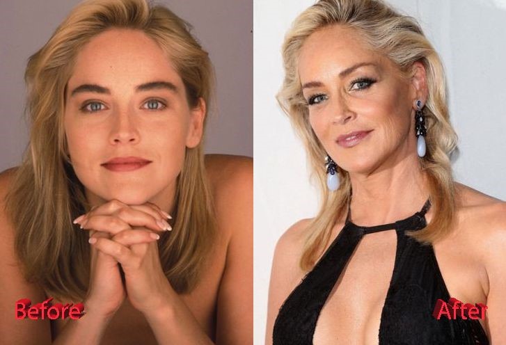 Sharon Stone before and after plastic surgery