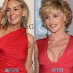 Sharon Stone plastic surgery (36)