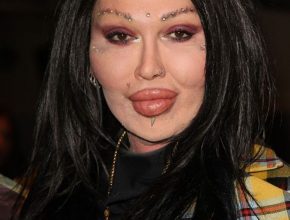 Pete Burns after plastic surgery