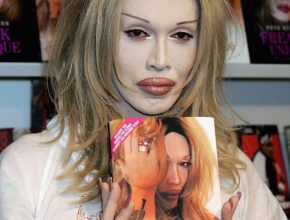 Pete Burns after plastic surgery 32