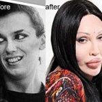 Pete Burns before and after plastic surgery 23