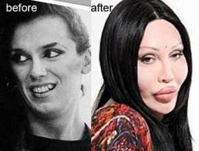 Pete Burns before and after plastic surgery 23