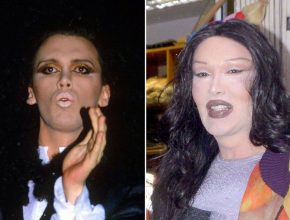 Pete Burns before and after plastic surgery 38