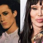 Pete Burns before and after plastic surgery