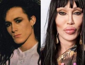 Pete Burns before and after plastic surgery
