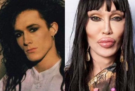 pete-burns-before-and-after-plastic-surgery