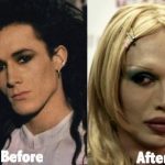 Pete Burns before and after plastic surgery 44