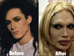 Pete Burns before and after plastic surgery 44